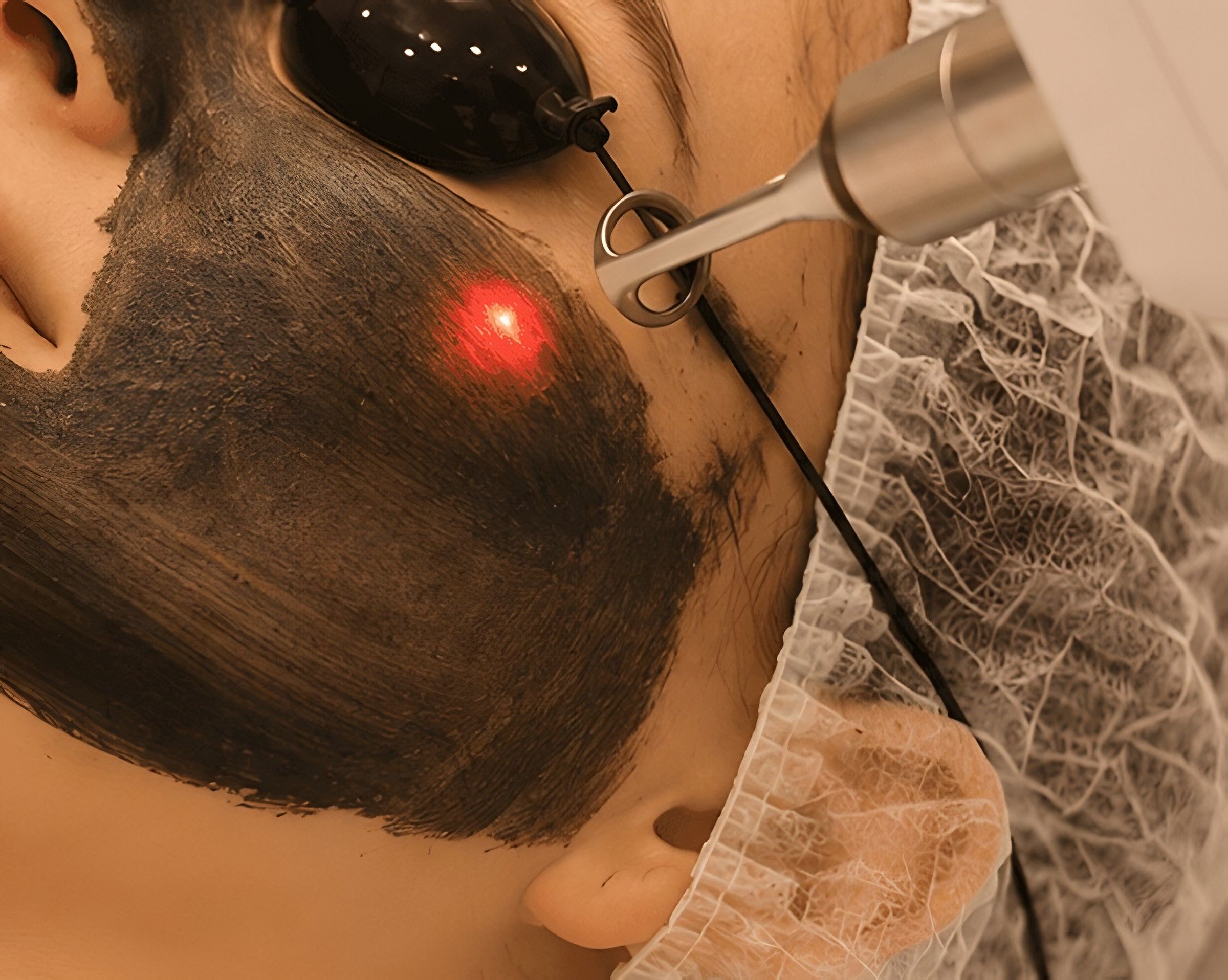 Deep-cleansing laser facial being performed on acne-prone skin